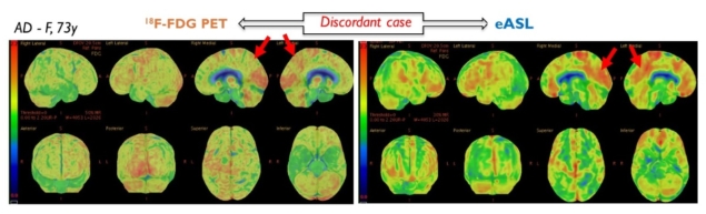 Diagnosing Alzheimer