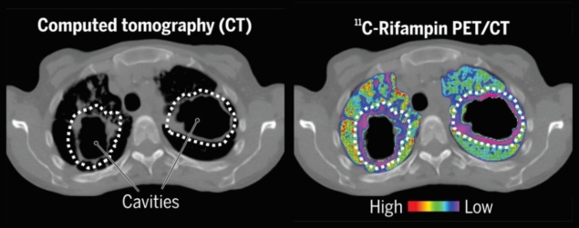 PET/CT scan